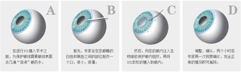 2000度近视?这生活还怎么过?